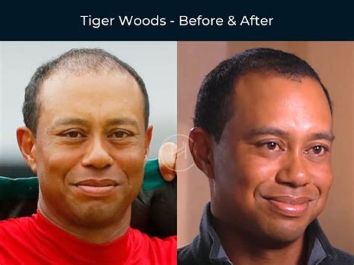 Has Tiger Woods Had Plastic Surgery? Who is Tiger Woods?
